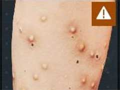 检疫区最后一站皮疹症状怎么处理？皮疹症状介绍